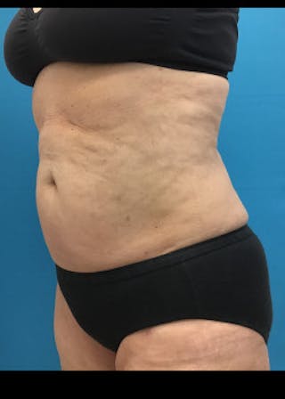 Liposuction Before & After Gallery - Patient 46613161 - Image 6
