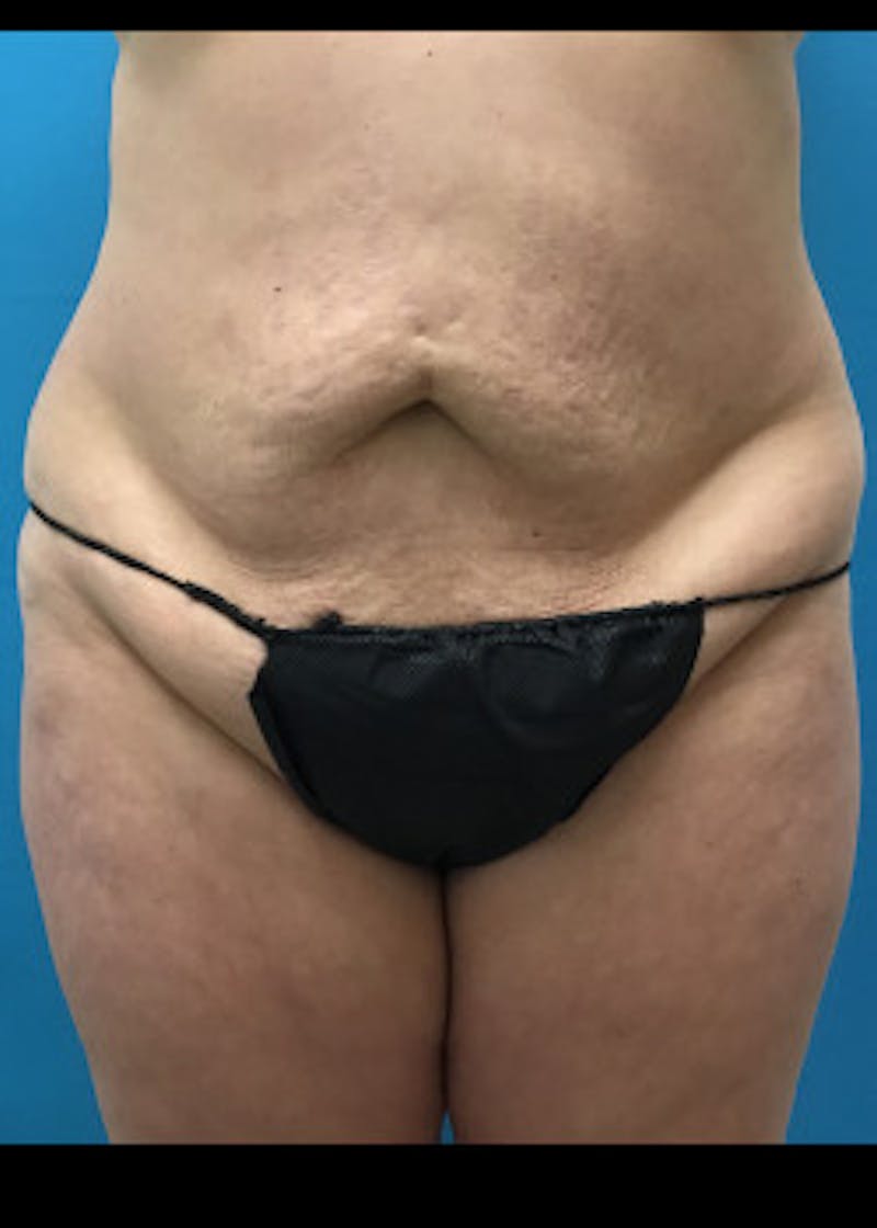 Liposuction Before & After Gallery - Patient 46613168 - Image 1