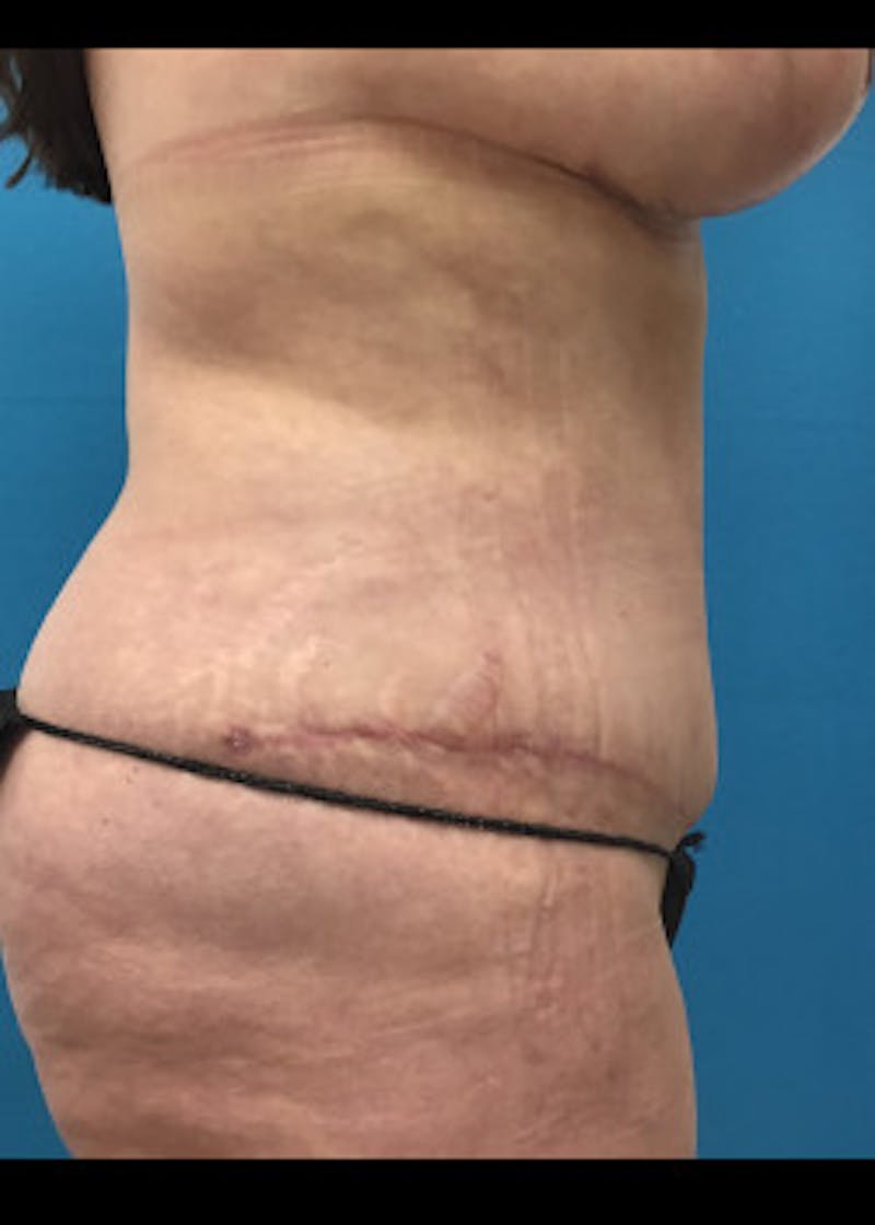 Liposuction Before & After Gallery - Patient 46613168 - Image 4