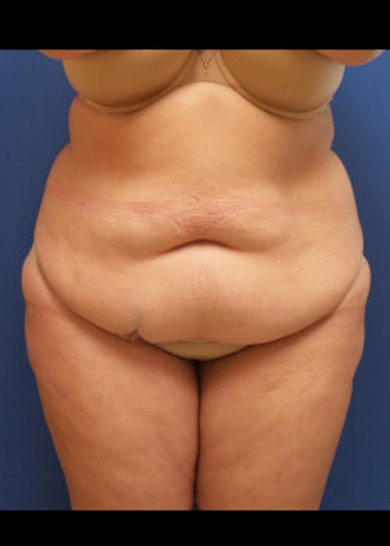 Liposuction Before & After Gallery - Patient 46613176 - Image 1