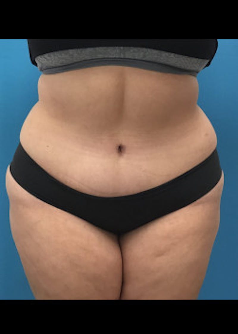 Liposuction Before & After Gallery - Patient 46613176 - Image 2