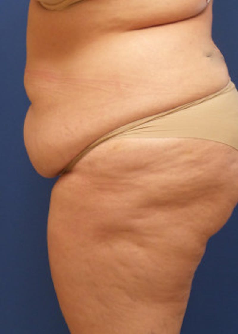 Liposuction Before & After Gallery - Patient 46613176 - Image 3