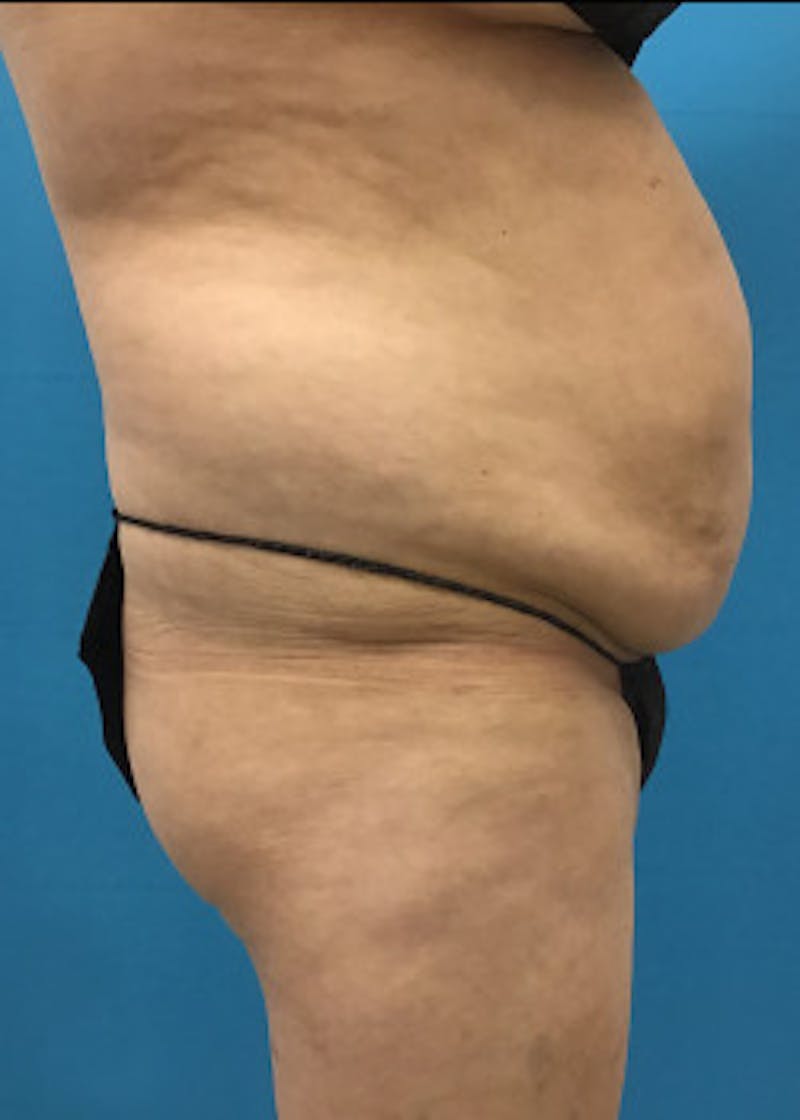 Liposuction Before & After Gallery - Patient 46613177 - Image 1