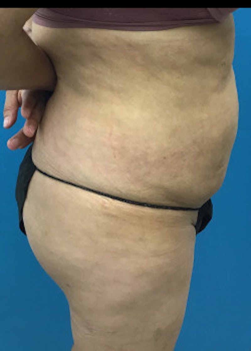 Liposuction Before & After Gallery - Patient 46613177 - Image 2