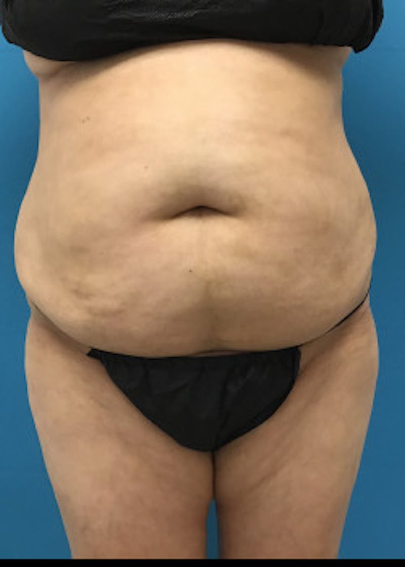 Liposuction Before & After Gallery - Patient 46613177 - Image 3