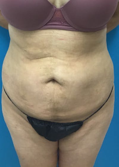Liposuction Before & After Gallery - Patient 46613177 - Image 2