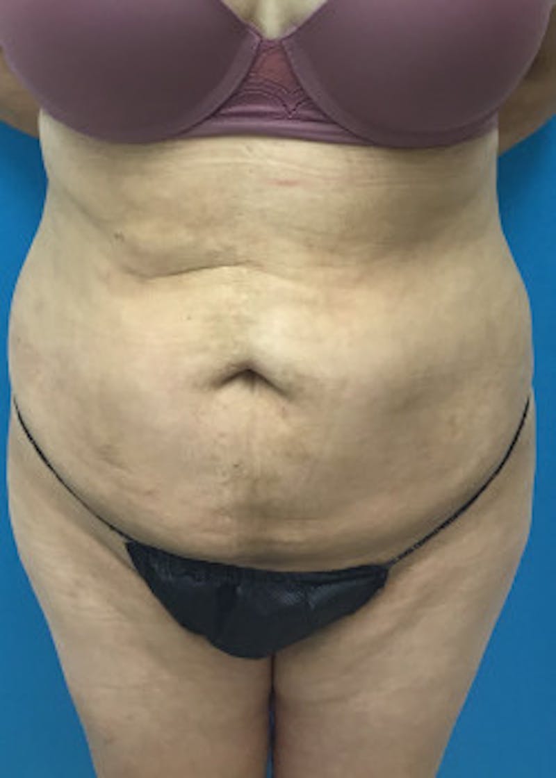 Liposuction Before & After Gallery - Patient 46613177 - Image 4