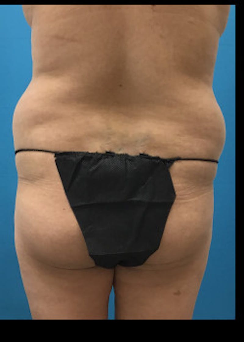 Liposuction Before & After Gallery - Patient 46613177 - Image 5