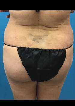 Liposuction Gallery - Patient 46613177 - Image 6