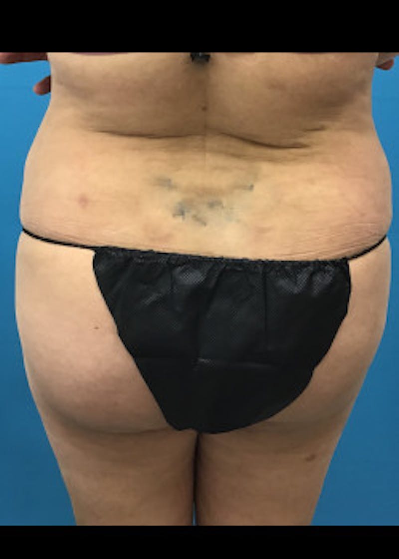 Liposuction Before & After Gallery - Patient 46613177 - Image 6