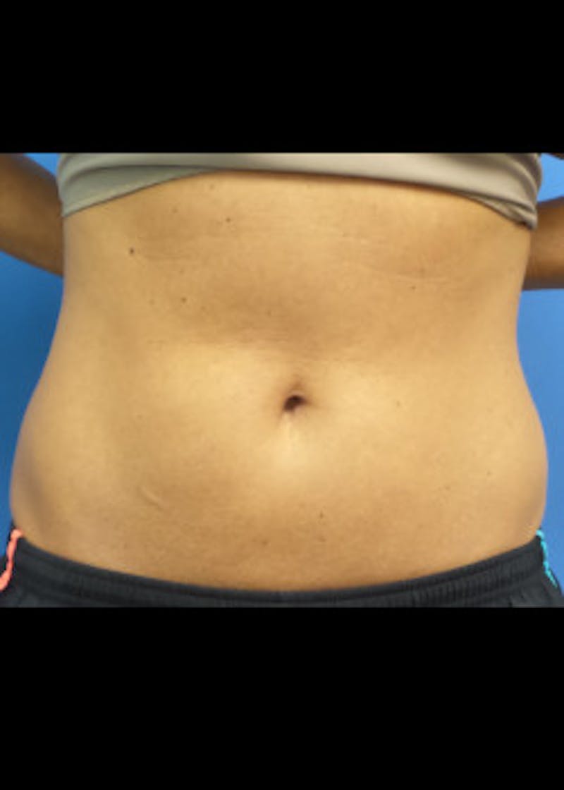 Liposuction Before & After Gallery - Patient 46613178 - Image 3