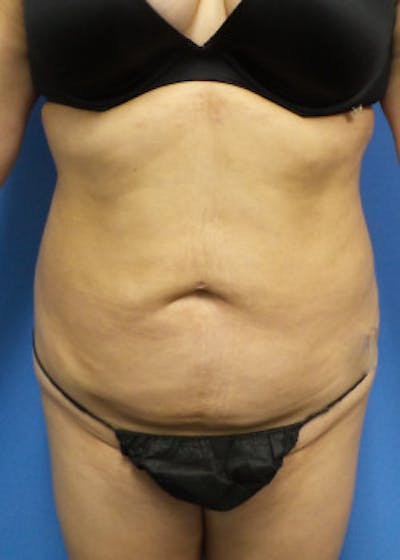 Liposuction Before & After Gallery - Patient 46613186 - Image 2