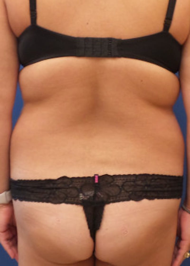 Liposuction Before & After Gallery - Patient 46613186 - Image 3