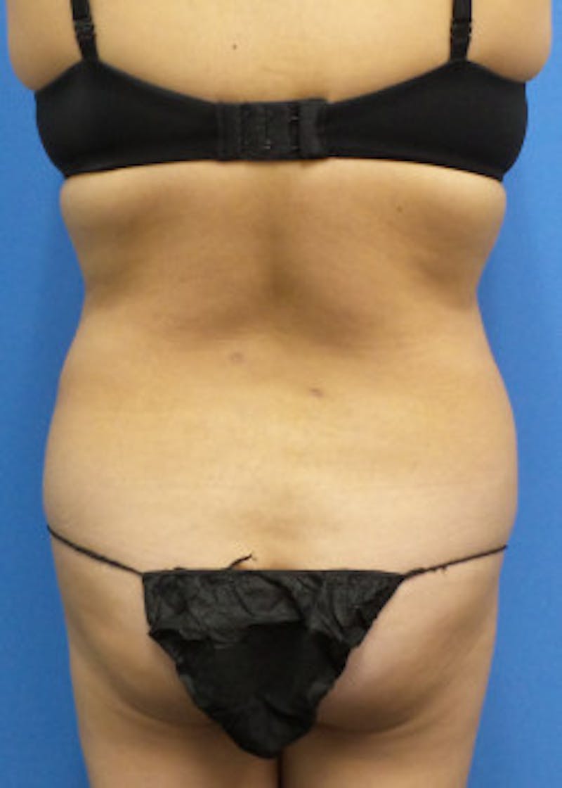 Liposuction Before & After Gallery - Patient 46613186 - Image 4