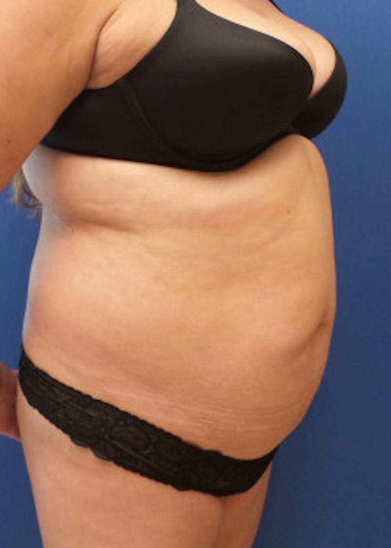 Liposuction Before & After Gallery - Patient 46613186 - Image 5