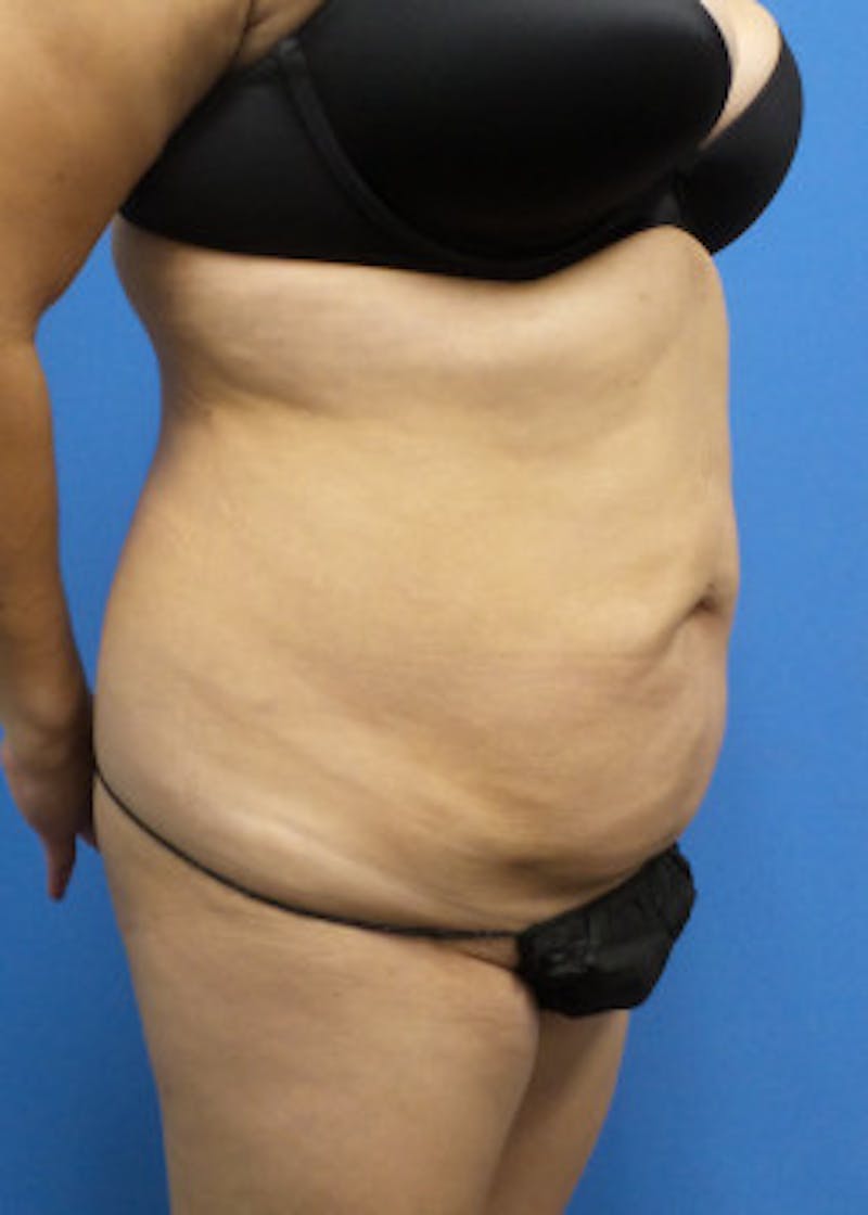 Liposuction Before & After Gallery - Patient 46613186 - Image 6