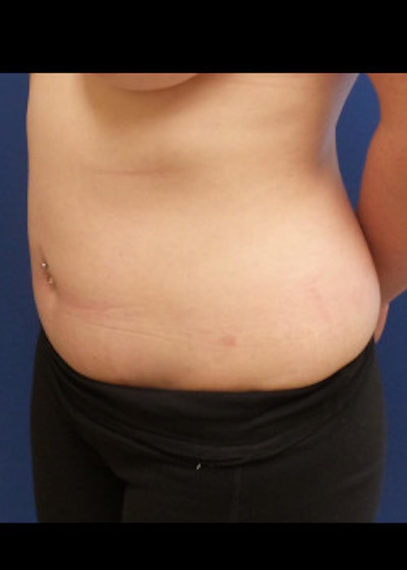 Liposuction Before & After Gallery - Patient 46613187 - Image 1