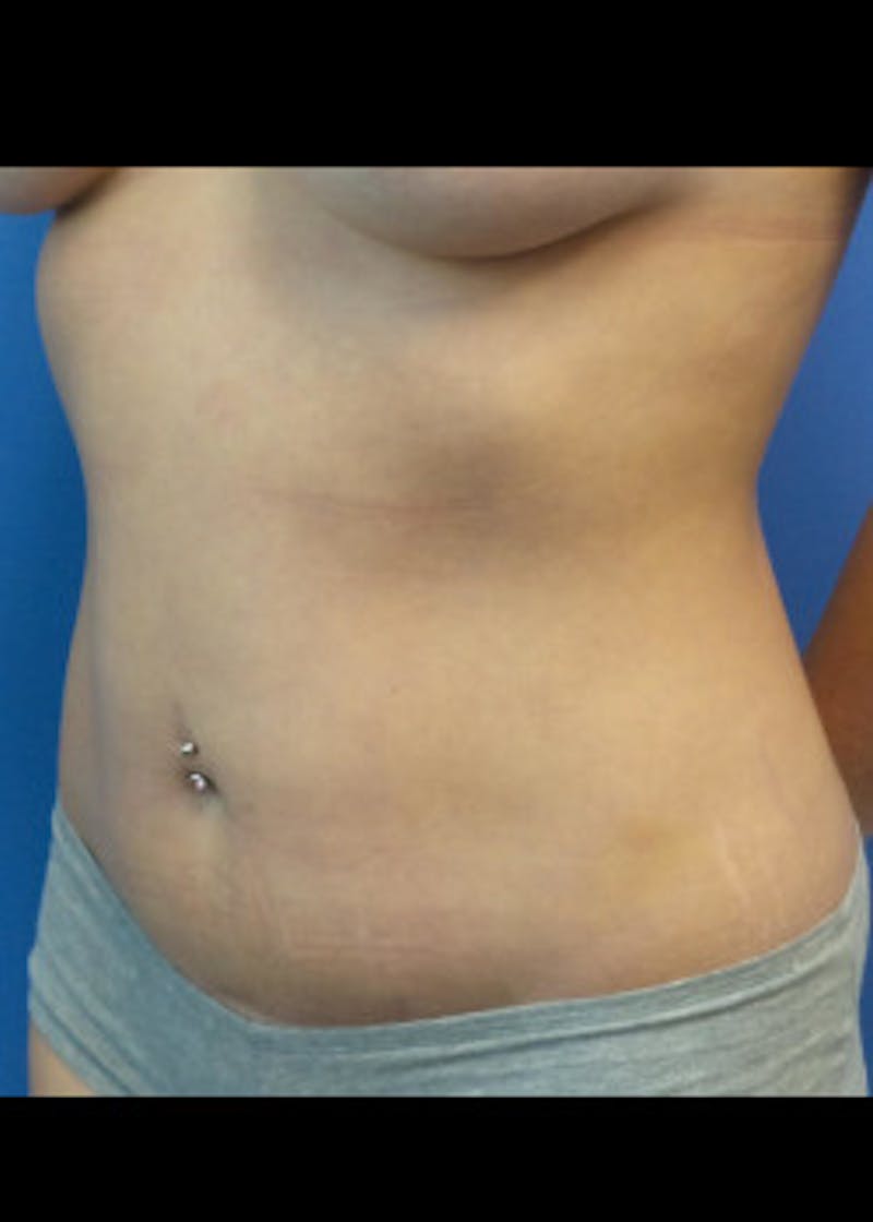 Liposuction Before & After Gallery - Patient 46613187 - Image 2