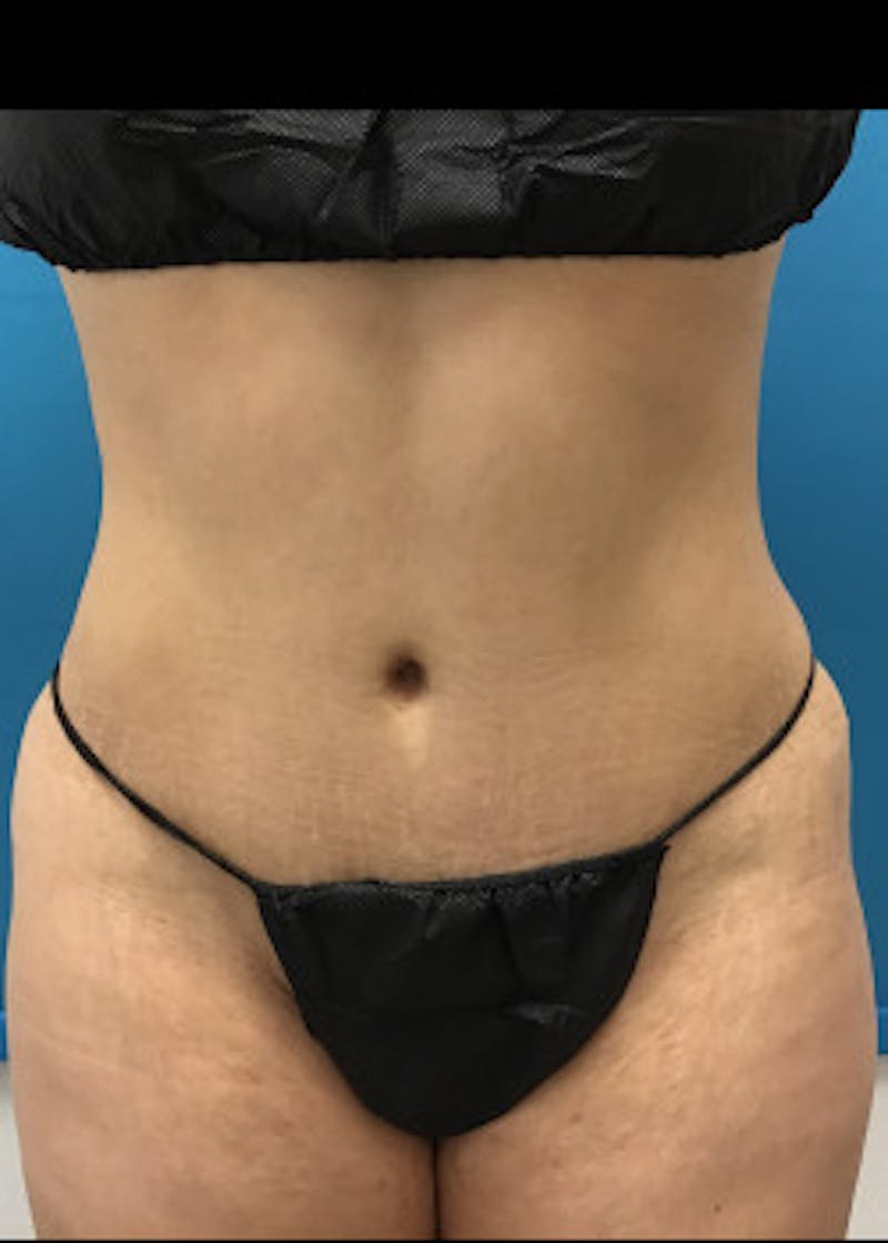 Liposuction Before & After Gallery - Patient 46613210 - Image 1