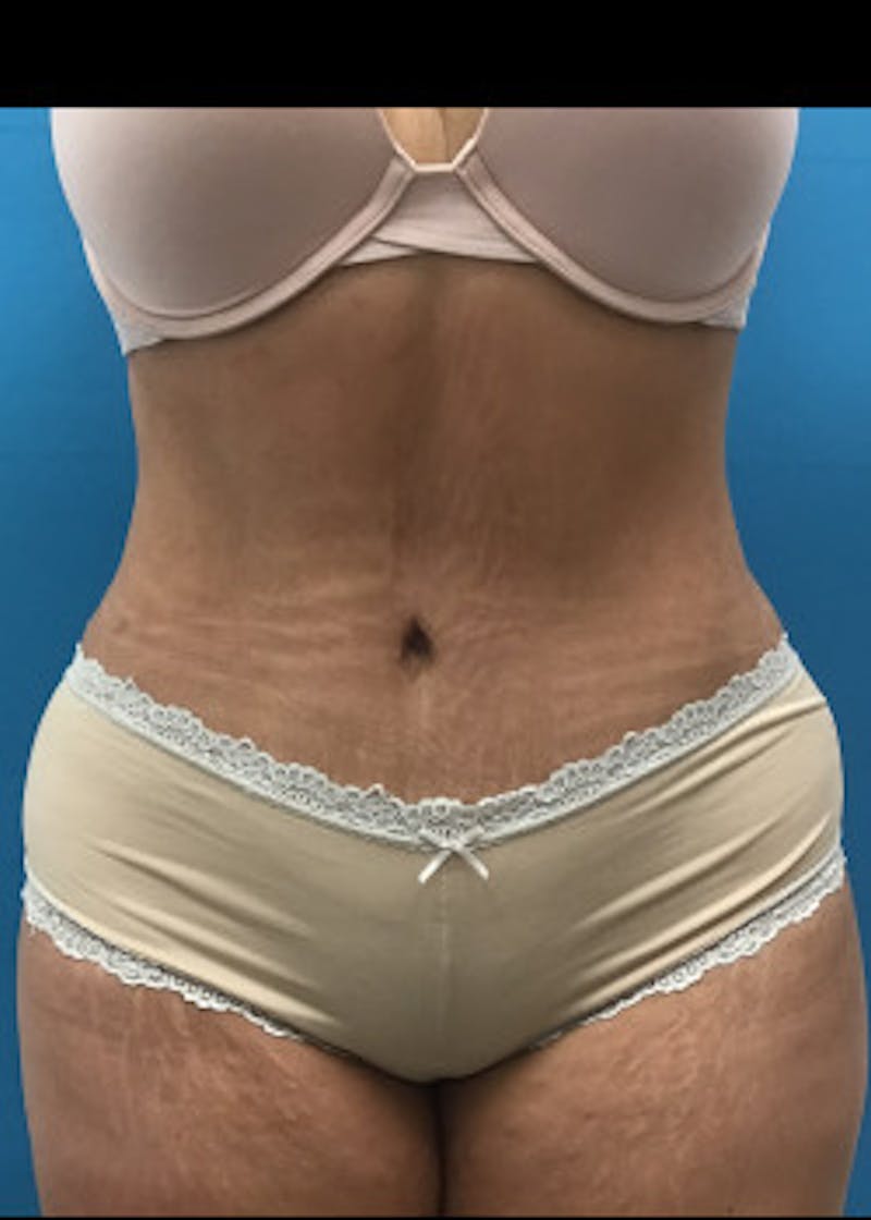 Liposuction Before & After Gallery - Patient 46613210 - Image 2
