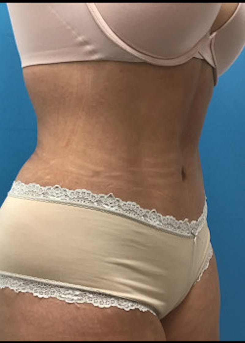 Liposuction Before & After Gallery - Patient 46613210 - Image 4