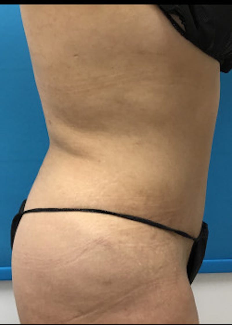 Liposuction Before & After Gallery - Patient 46613210 - Image 5