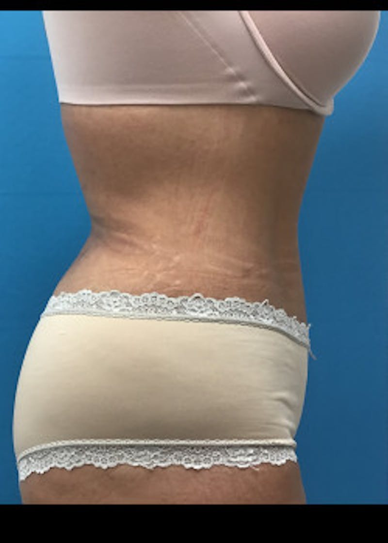 Liposuction Before & After Gallery - Patient 46613210 - Image 6