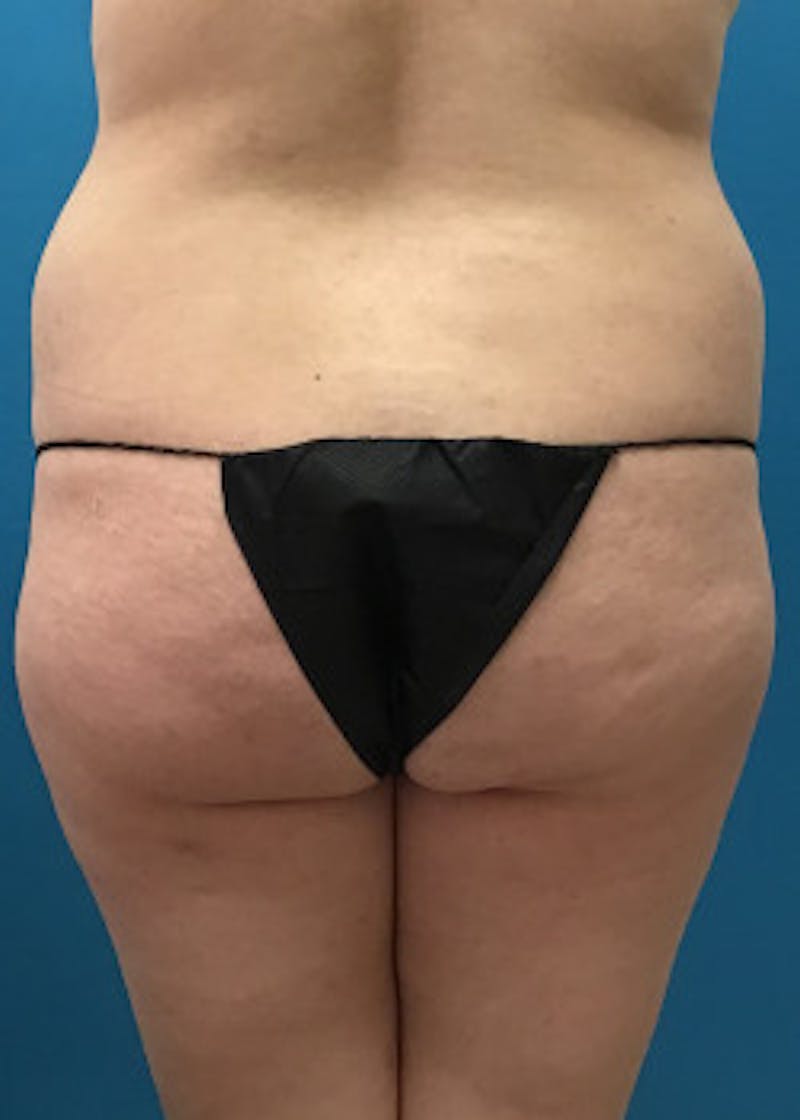 Liposuction Before & After Gallery - Patient 46613219 - Image 1