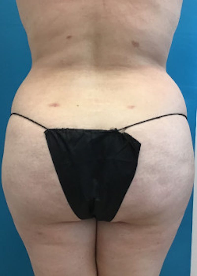 Liposuction Before & After Gallery - Patient 46613219 - Image 2