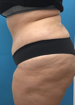 Liposuction Before & After Gallery - Patient 46613596 - Image 4