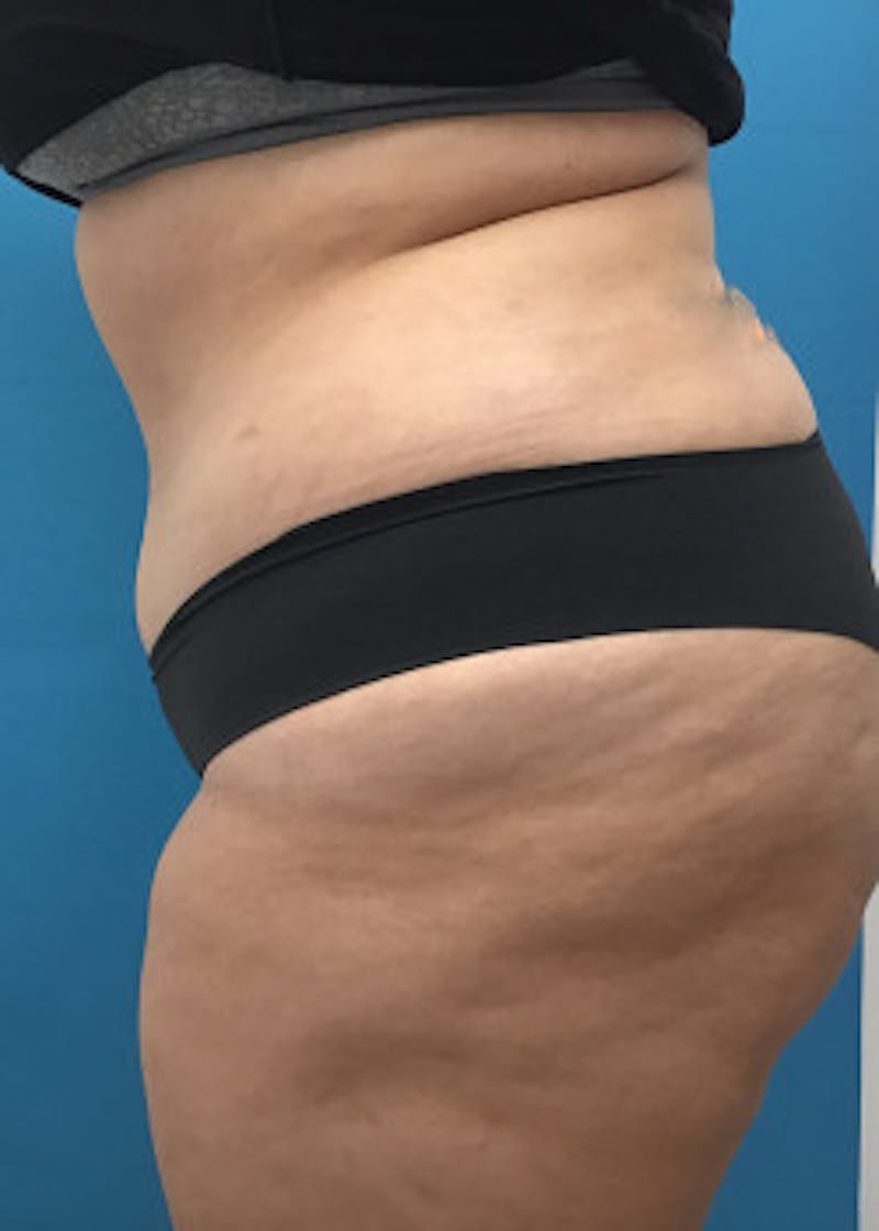 Liposuction Before & After Gallery - Patient 46613596 - Image 4