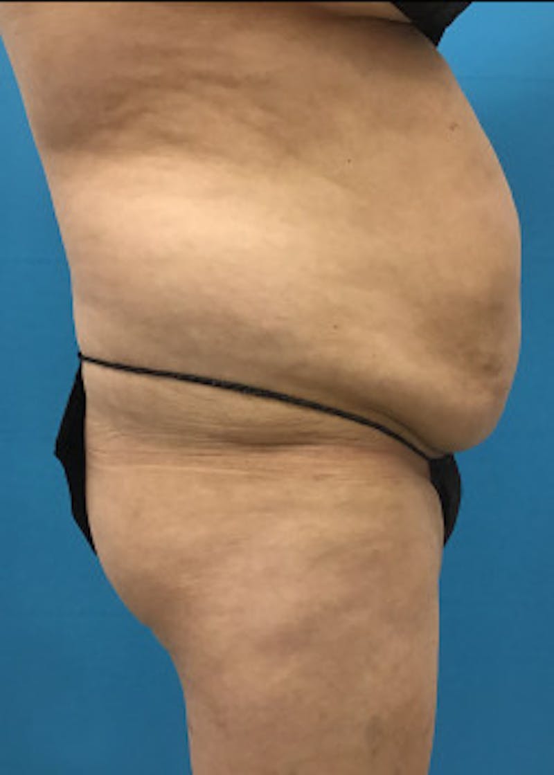 Liposuction Before & After Gallery - Patient 46613597 - Image 1