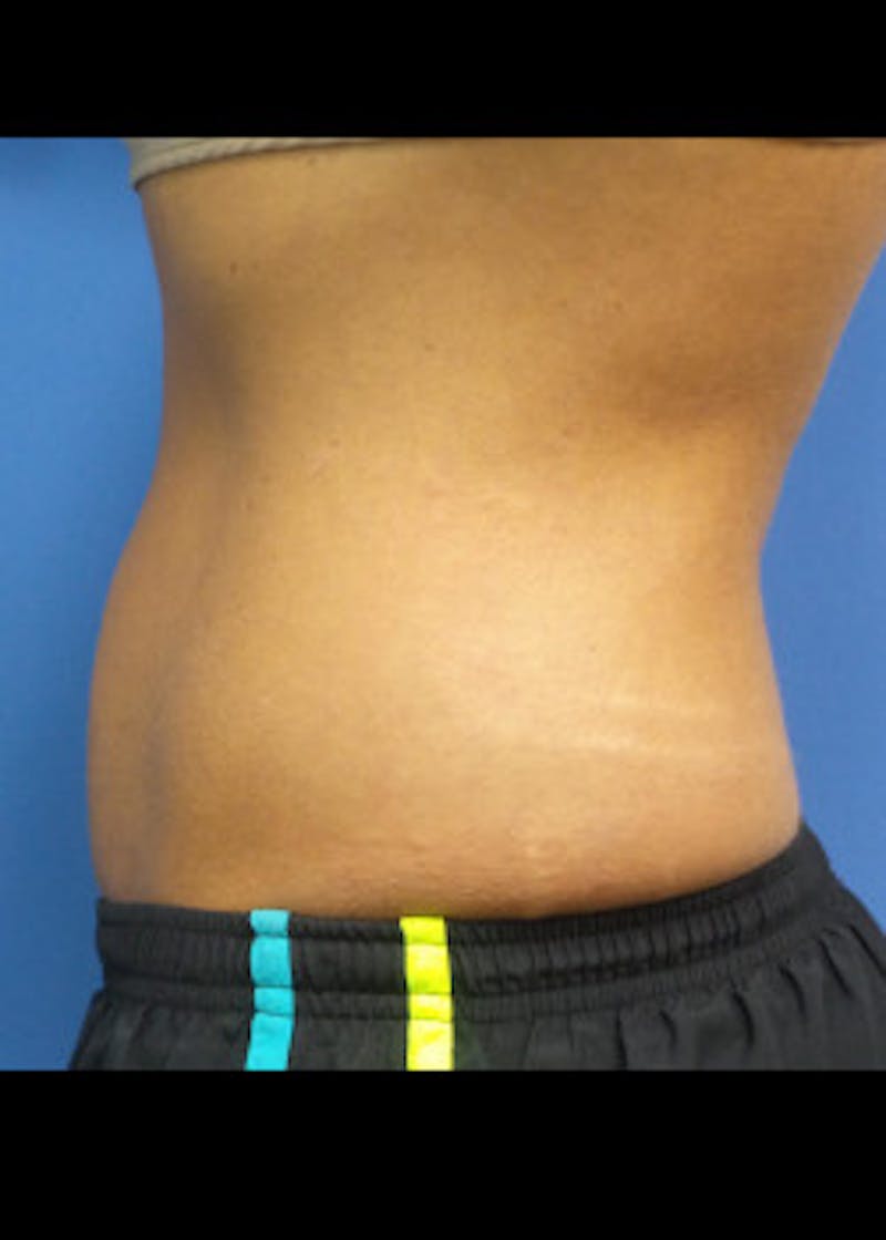 Liposuction Before & After Gallery - Patient 46613598 - Image 1