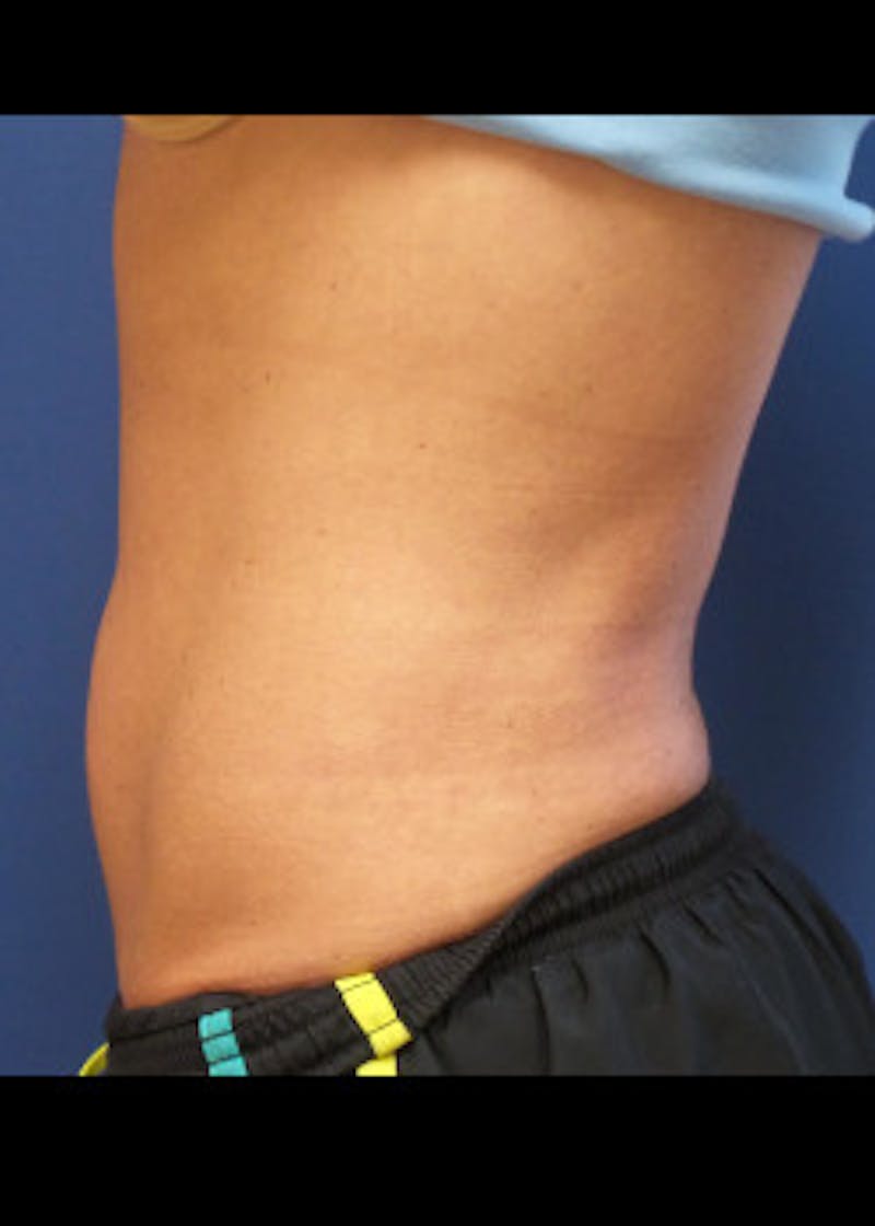 Liposuction Before & After Gallery - Patient 46613598 - Image 2