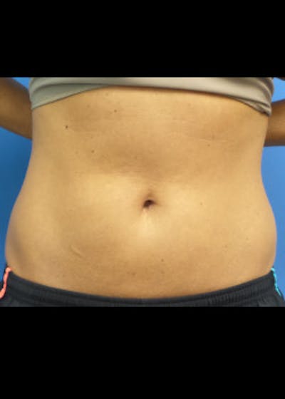 Liposuction Before & After Gallery - Patient 46613598 - Image 1
