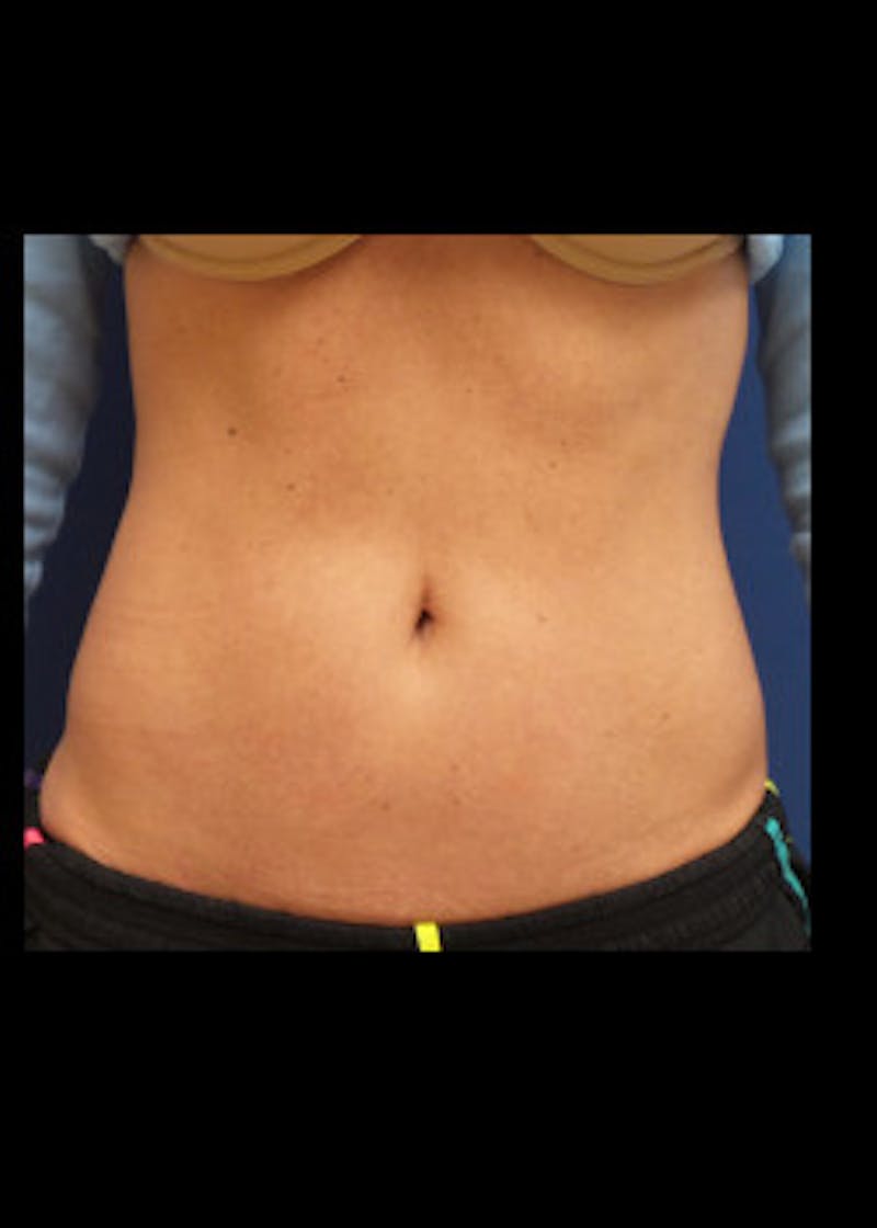Liposuction Before & After Gallery - Patient 46613598 - Image 4