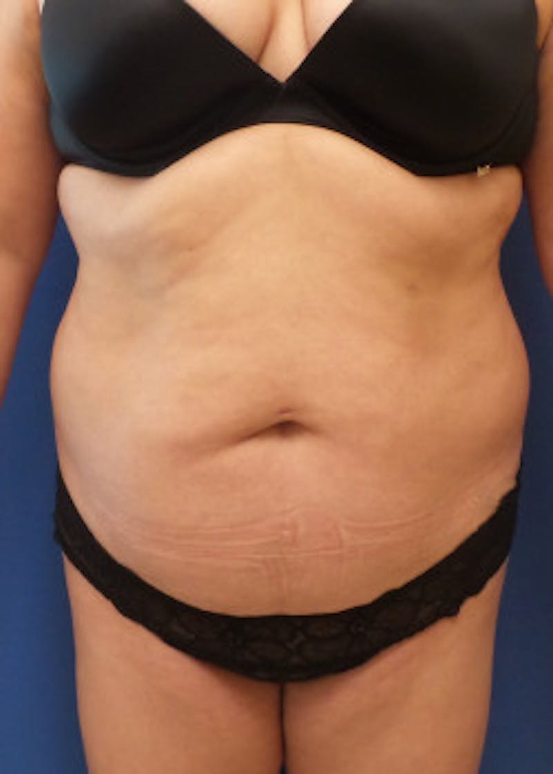 Liposuction Before & After Gallery - Patient 46613601 - Image 1