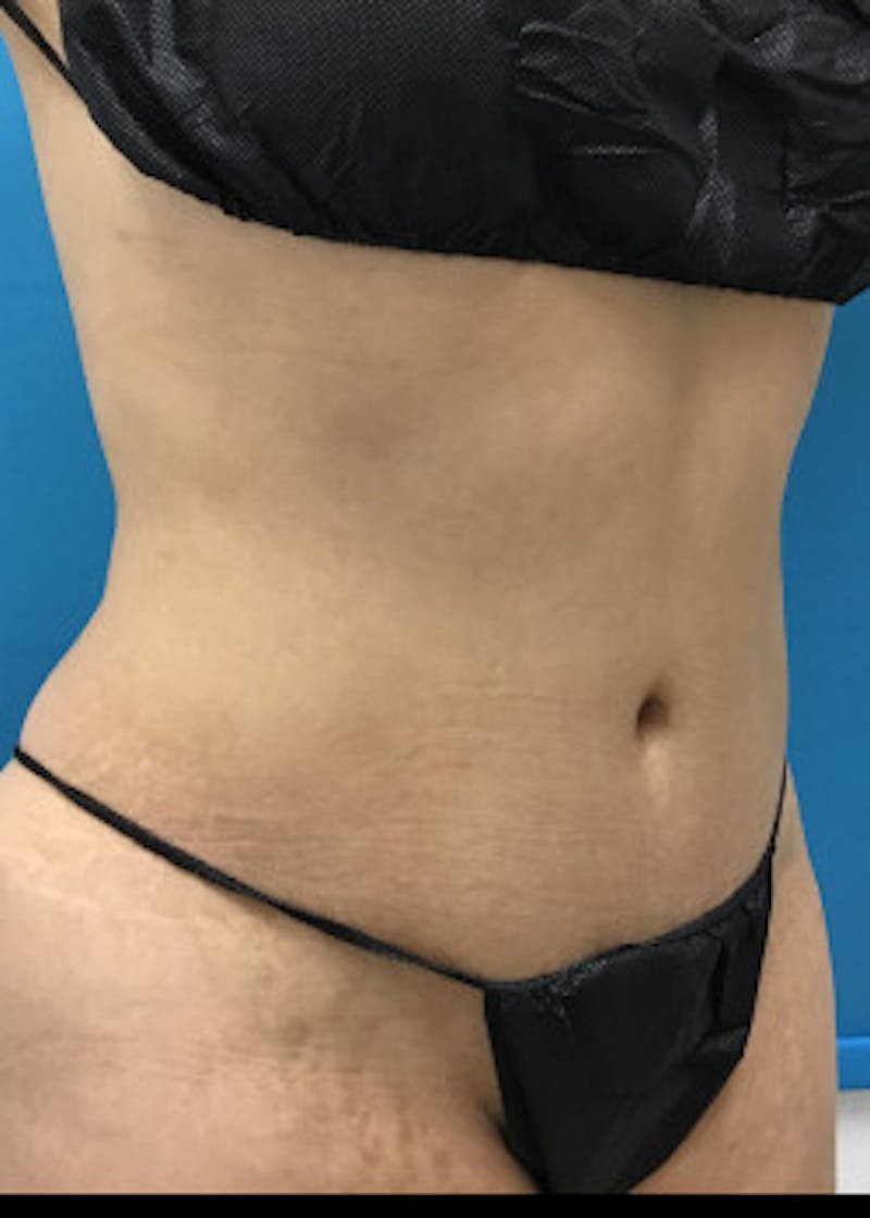 Liposuction Before & After Gallery - Patient 46613604 - Image 3