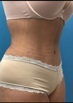 Liposuction Gallery - Patient 46613604 - Image 4