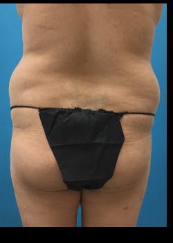 Liposuction Gallery - Patient 46613907 - Image 5