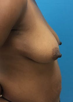 Breast Augmentation Gallery - Patient 46614240 - Image 3