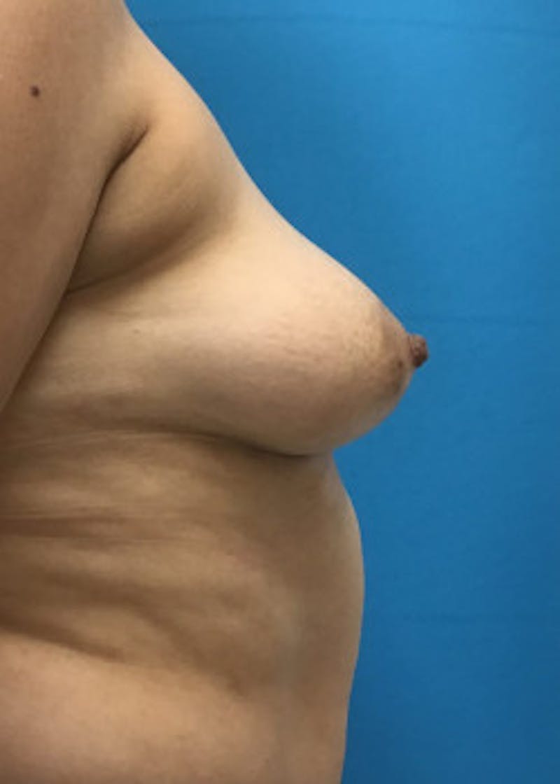 Breast Augmentation Before & After Gallery - Patient 46614274 - Image 3