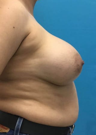 Breast Augmentation Before & After Gallery - Patient 46614274 - Image 4