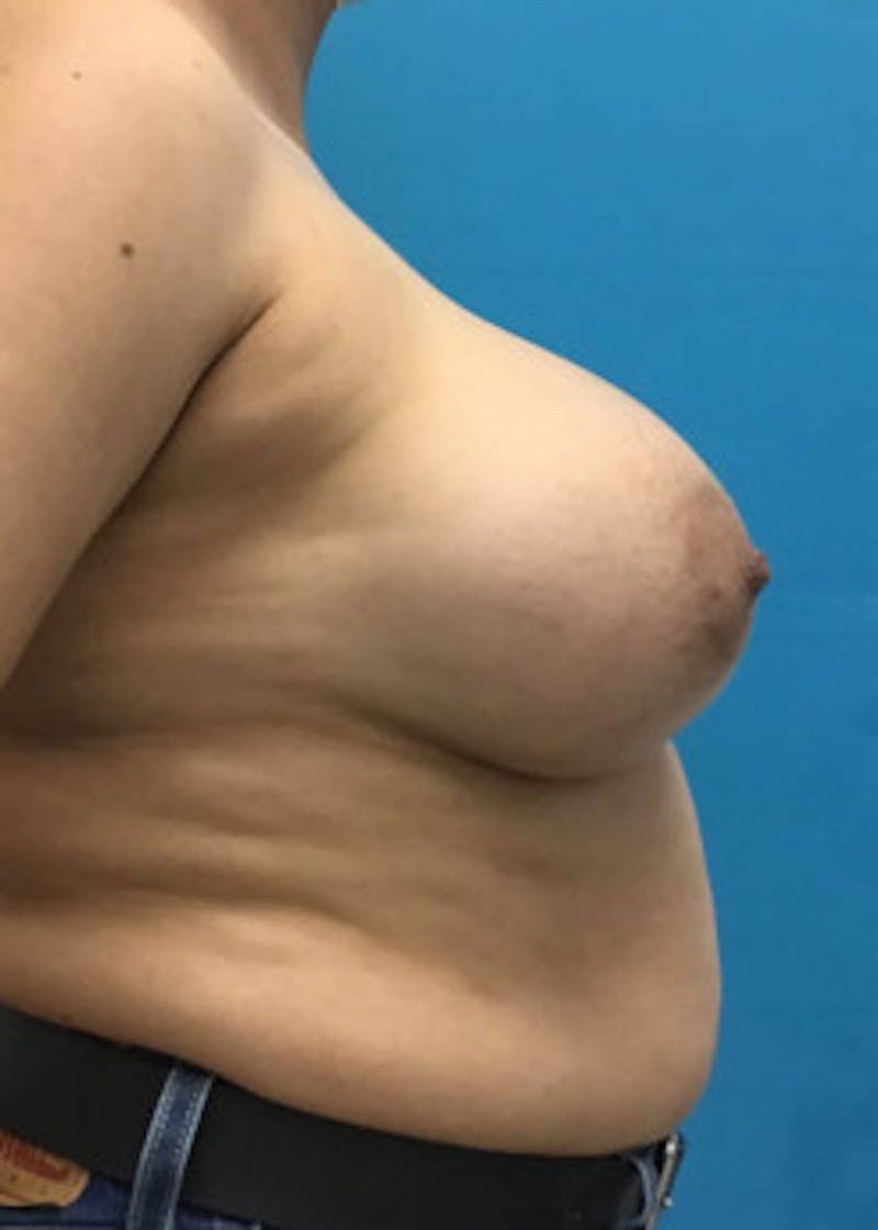 Breast Augmentation Before & After Gallery - Patient 46614274 - Image 4