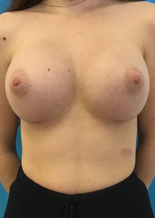 Breast Augmentation Before & After Gallery - Patient 46614330 - Image 2