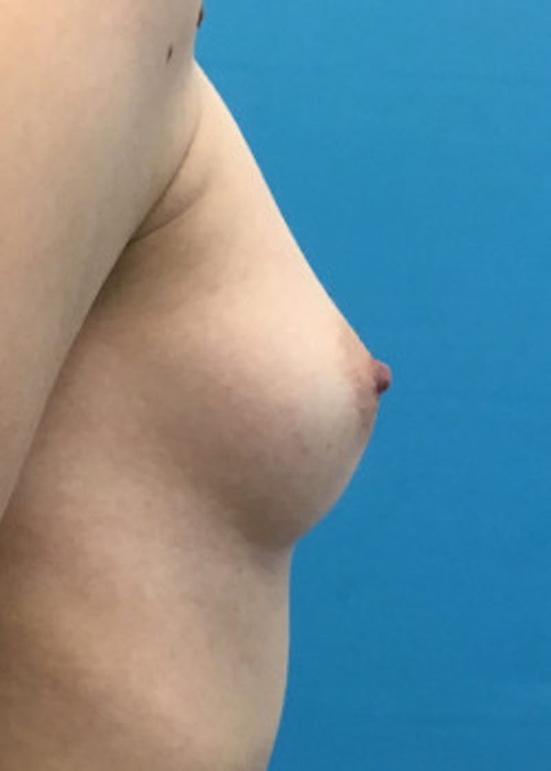Breast Augmentation Before & After Gallery - Patient 46614330 - Image 5