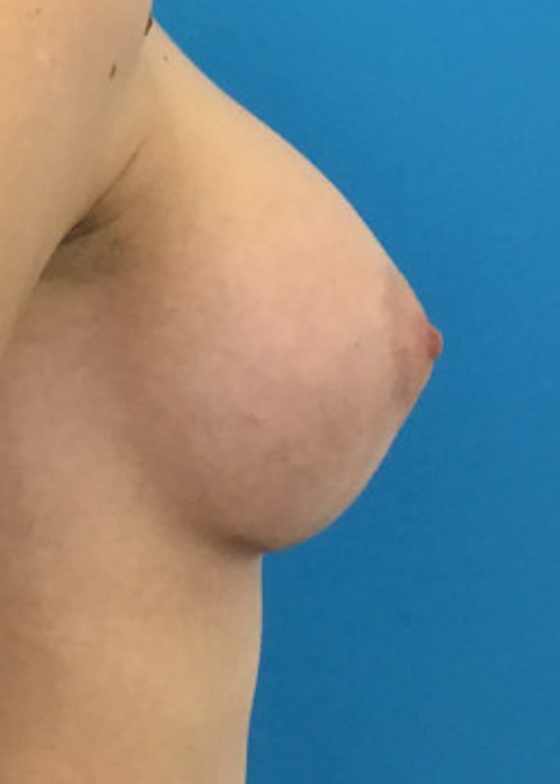 Breast Augmentation Before & After Gallery - Patient 46614330 - Image 6