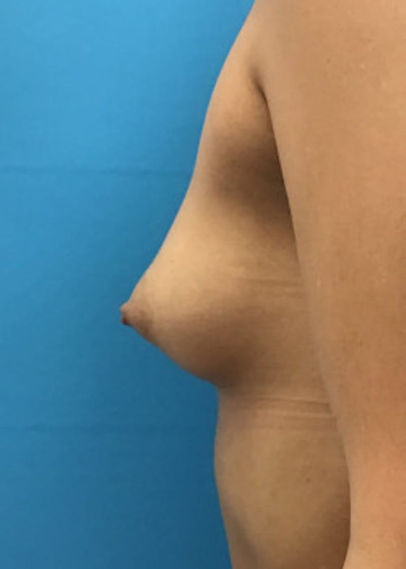 Breast Augmentation Before & After Gallery - Patient 46614353 - Image 3