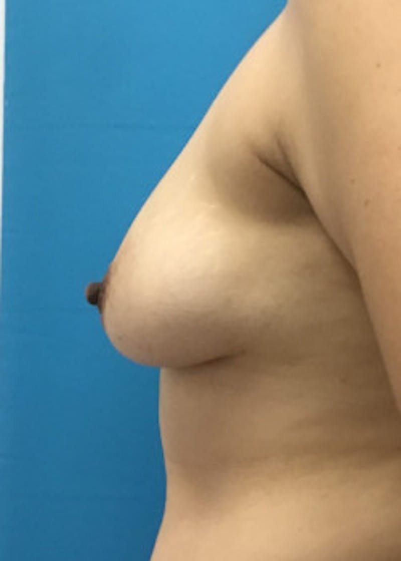 Breast Augmentation Before & After Gallery - Patient 46614387 - Image 3