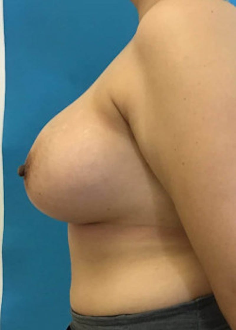Breast Augmentation Before & After Gallery - Patient 46614387 - Image 4
